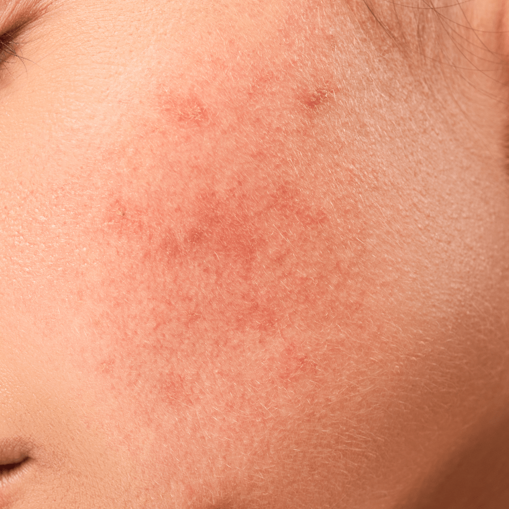 Pigment Fader for Redness and Blemishes